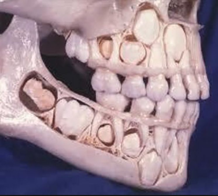 74-childs-skull-with-complete-set-of-teeth